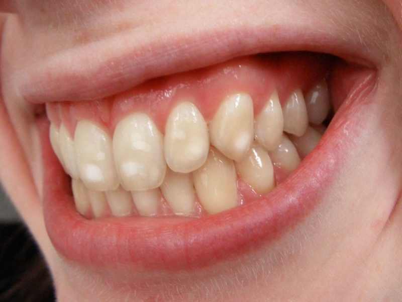 فلور باعث افزایش مقاومت دندان در مقبال باکتری ها می شود